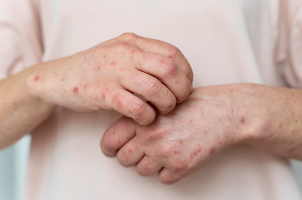 Bị thuỷ đậu kiêng gì để nhanh khỏi? Hướng dẫn chăm sóc từ A – Z